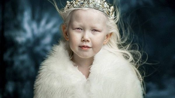 8letnia albinoska